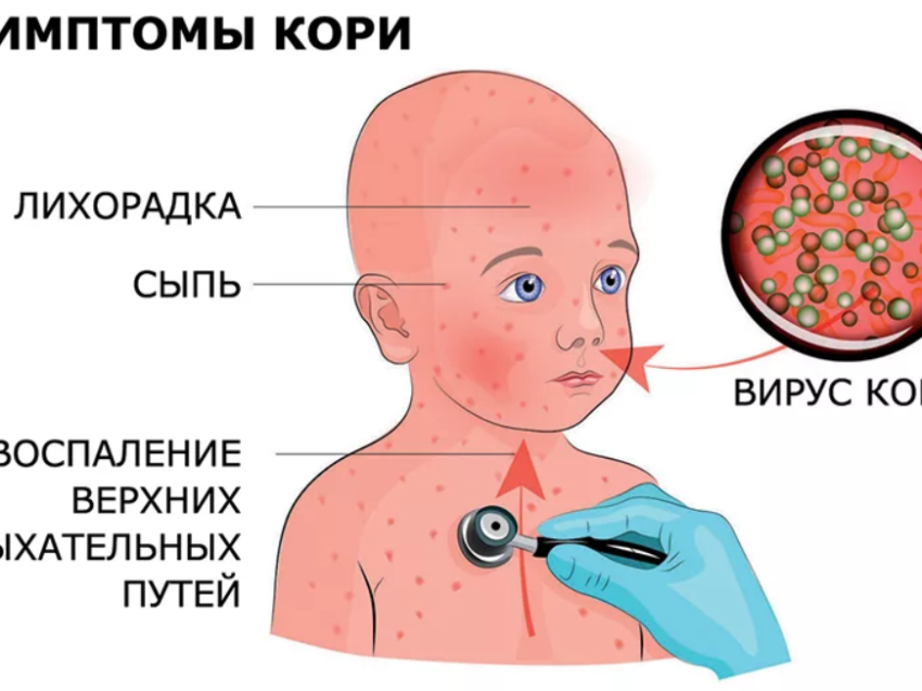 Поставьте прививку. Прививка защитит Вас от кори!